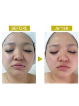 ルルン(LuLuN)/ラジオ波フェイシャルの効果