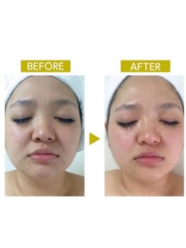 ルルン(LuLuN)/ラジオ波フェイシャルの効果