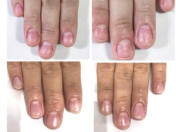 自爪ケアサロン 横浜/深爪矯正 初回9月→ご卒業12月