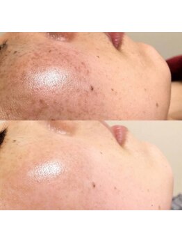 シミしわ改善！予防ケア