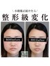 小顔矯正＋高濃度酸素オイルリンパ¥9,900→¥8,400【エラ張り /浮腫 】