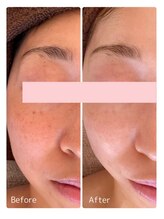 ククル(KUKULU)/陶肌ピール6回目♪(30代後半女性