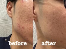 ソラナ(Solana)/肌質改善（美容鍼×セルサー）