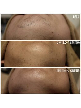 ベビースキン(baby skin)/髭脱毛