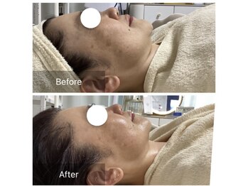 ダリア(Dahlia)/最新リフトアップマシン