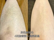 エクレ 柏店(EKURE)/メンズ脚脱毛
