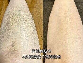エクレ 柏店(EKURE)/メンズ脚脱毛