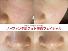 【肌質改善】毛穴の開き・乾燥肌改善フェイシャルであの頃の肌へ
