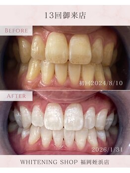 ホワイトニングショップ 福岡姪浜店/美白ホワイトニングbefore after