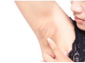 ベラ(VERA)の写真/そろそろ夏に向けて、わき・Vゾーン/ビキニラインの黒ずみ/色素ケア&脱毛ケアできれいにしましょう!