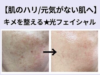 ベル アージュ/感動!光フェイシャル