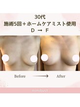 ミミバスト(mimibust)/バストアップBeforeAfter