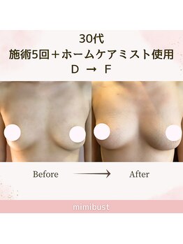 ミミバスト(mimibust)/バストアップBeforeAfter