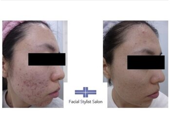 フェイシャルスタイリストサロン 四谷店/ケア例(19)