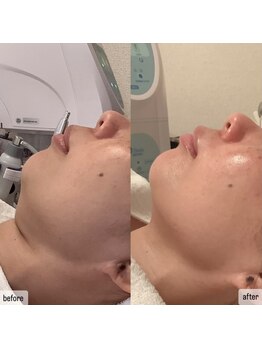 エムベル(M.belle)/リフトアップマッサージ2回