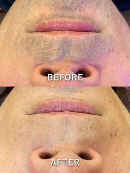 ジェンヌ(jenne.)/清潔感◎ヒゲ脱毛