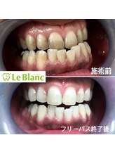 ルブラン 奈良店(Le Blanc)/長年の黄ばみ！