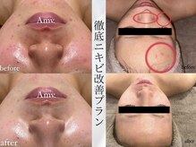 エメ マヴィ(Amour mavie)の雰囲気（【ニキビケア】肌艶生み出すテクニック！ハーブトリートメント）