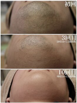 ベビースキン(baby skin)/髭脱毛