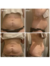 サロンドココ(Salon de CoCo.)/美腸ケアコース前後