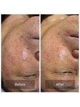 ビジュープラス 筑西下館店(Bijou+)/【70代お悩み】赤ら顔／1回