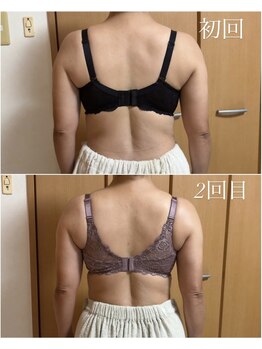 エース(A)/肩幅のお悩みバストケアで解決