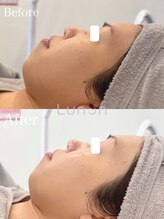 ルノン(Lunon)/毛穴洗浄ハイドロ×ララピール