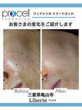 リベルテ(Liberte)/プロセルフェイシャル
