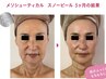 【50代からの本格エイジングケア】シミたるみ改善、幹細胞スノーピール