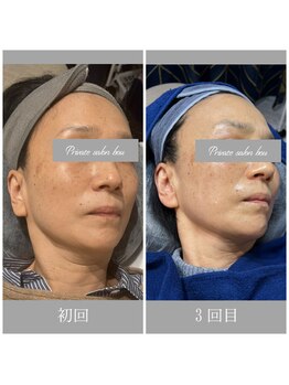 bou 新宿/美肌もSフェイス肌両方GET