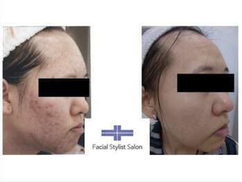 フェイシャルスタイリストサロン 四谷店/ケア例(20)