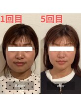 パンダ(Panda)/顎の歪み・食いしばり・小顔矯正