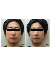 かとう鍼灸整骨院/◆３０男性　７回の施術例