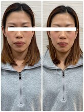 長寿鍼灸院 長寿整骨院/美容鍼25本の効果★小顔効果