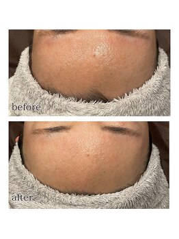 アデル 久留米(ADEL)/フェイシャルワックス《額》