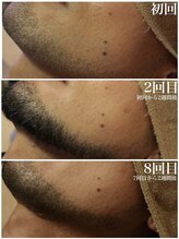 ベビースキン(baby skin)/髭脱毛