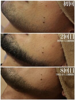 ベビースキン(baby skin)/髭脱毛