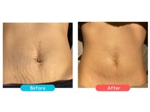 ミセル(MISEL2nd)/産後の肌ケアにWINBACK★