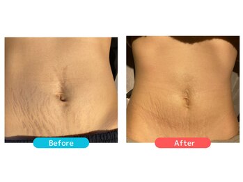 ミセル(MISEL2nd)/産後の肌ケアにWINBACK★