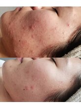 プシュケ(Psyche)/お客様の肌変化