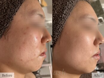 ティアラッシュ(TiaLash)/月1回のハーブトリートメント