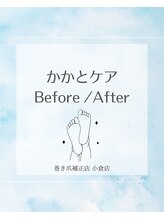 巻き爪補正店 小倉店/【かかとケア】