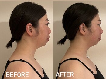 アンミー(anmiiy)/40代エアバリ変化/首肩頭