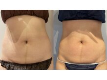 エイシスグロウ(asis glow.)/効果写真