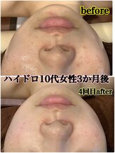 リソル(RISOL)/毛穴ケア大人気！！