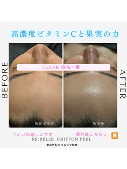 クリア 麻布十番(CLEAR)/シフォンピーリング　ピーリング