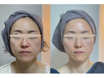 マザートウキョウ(Mother TOKYO)/ほうれい線改善できます!