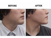 自由が丘ダツモウセンター(自由が丘 DATSUMOW CENTER)/ヒゲ脱毛～男性B様～