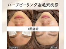 イーラボ 池袋店(e-LABO)/毛穴洗浄×国産ハーブピーリング