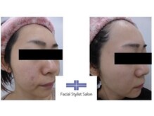 フェイシャルスタイリストサロン 四谷店/ケア例(22)
